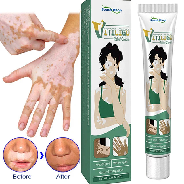 Herbal Extract - Vitiligo Ointment Remove Ringworm - White Spot Removal - Skin Vitiligo Eliminate Vitiligo Treatment Cream - White Spot Removal Cream Price in Pakistan