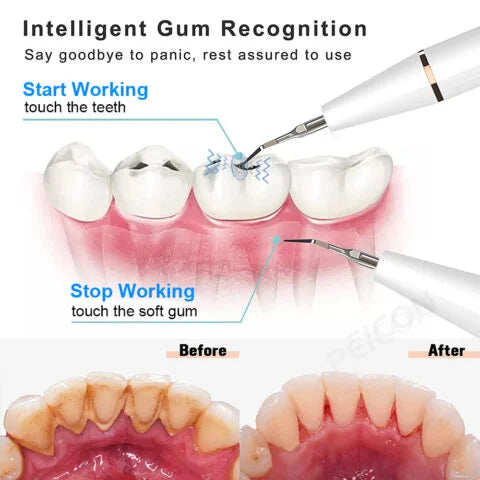 Ultrasonic Dental Tartar Remover Electric Ultra Sonic - Dental Calculus Remover Plaque Removal - Dental Scaler Tartar Eliminator - Dental Tartar Remover price in Pakistan